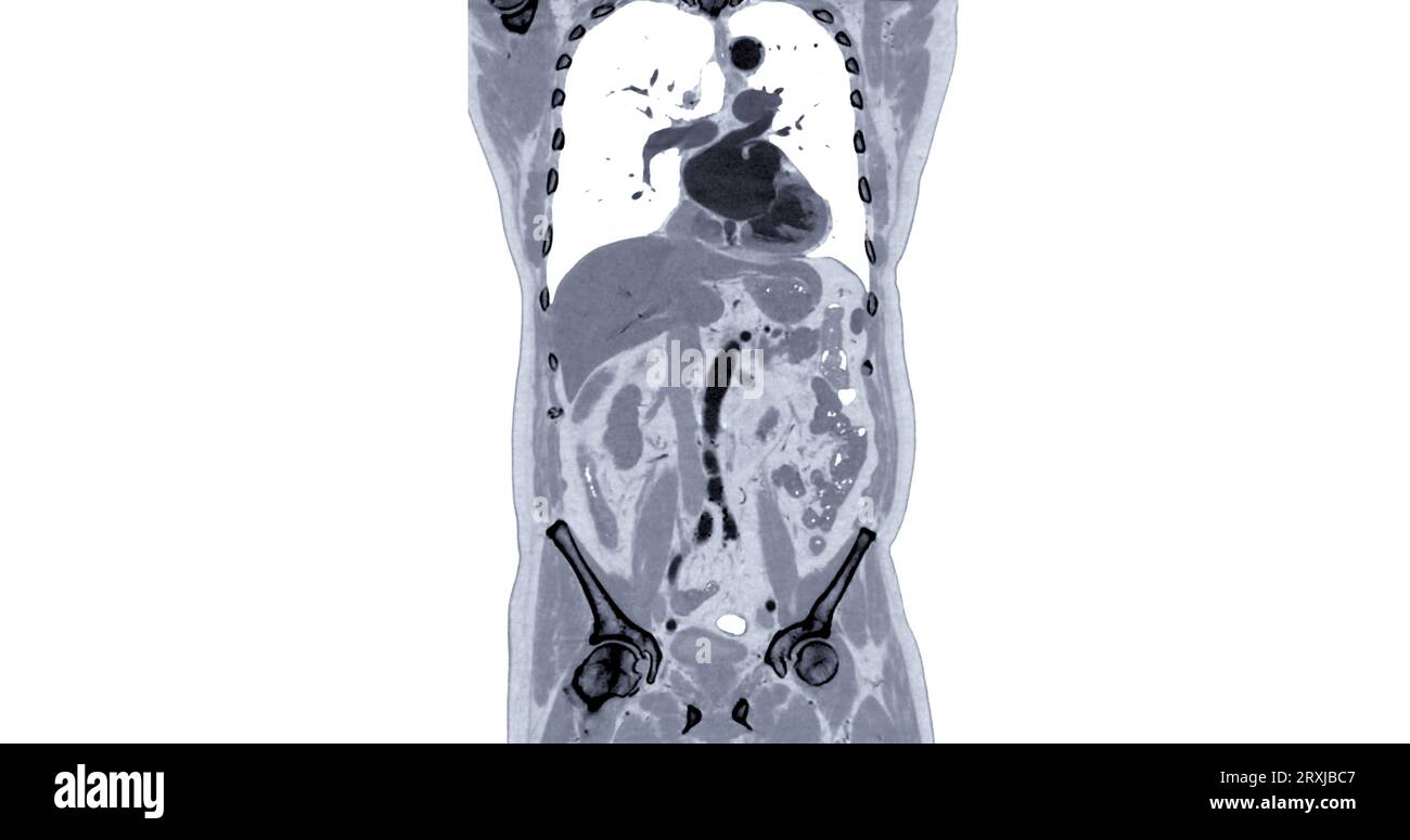 CT Chest and Abdomen with injection contrast media coronal view for