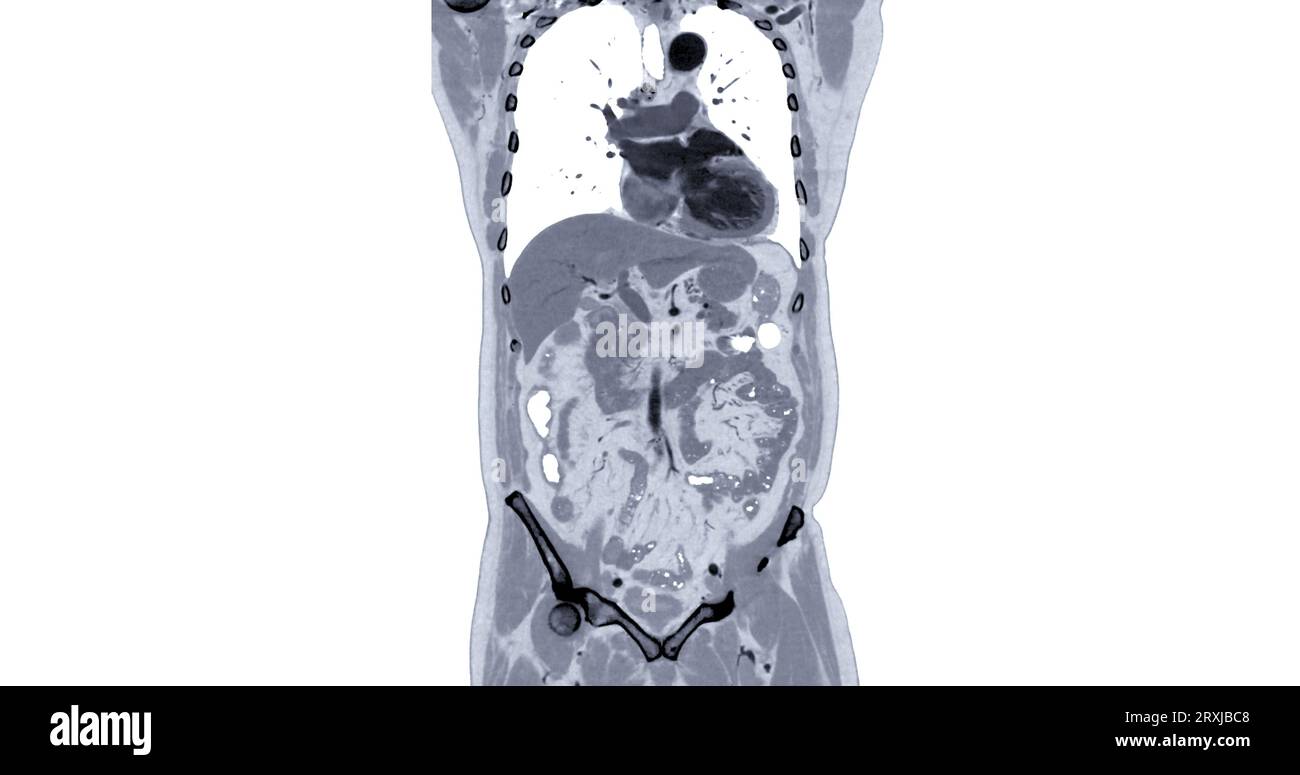 CT Chest and Abdomen with injection contrast media coronal view for diagnosis chest and