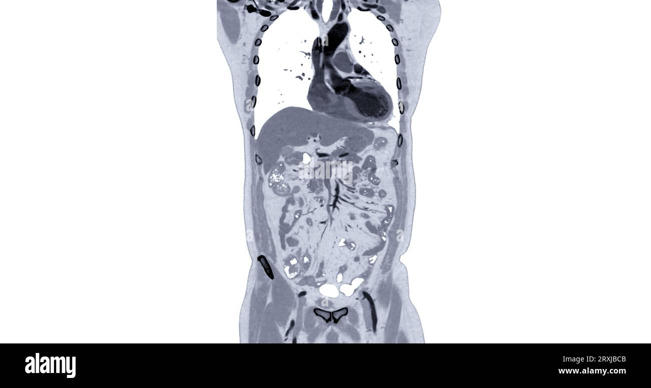 CT Chest and Abdomen with injection contrast media coronal view for diagnosis chest and