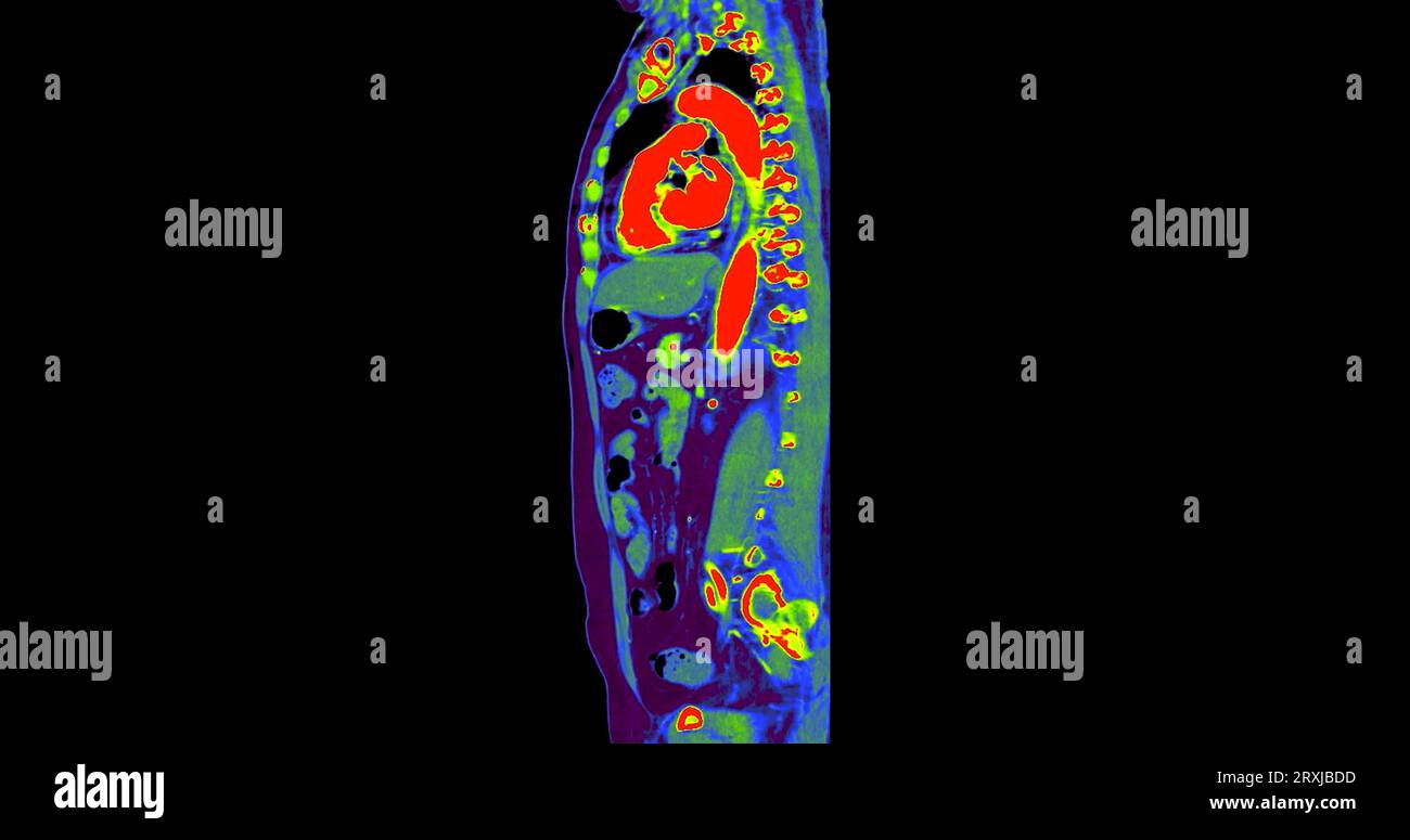 CT Chest and Abdomen with injection contrast media sagittal plane for ...