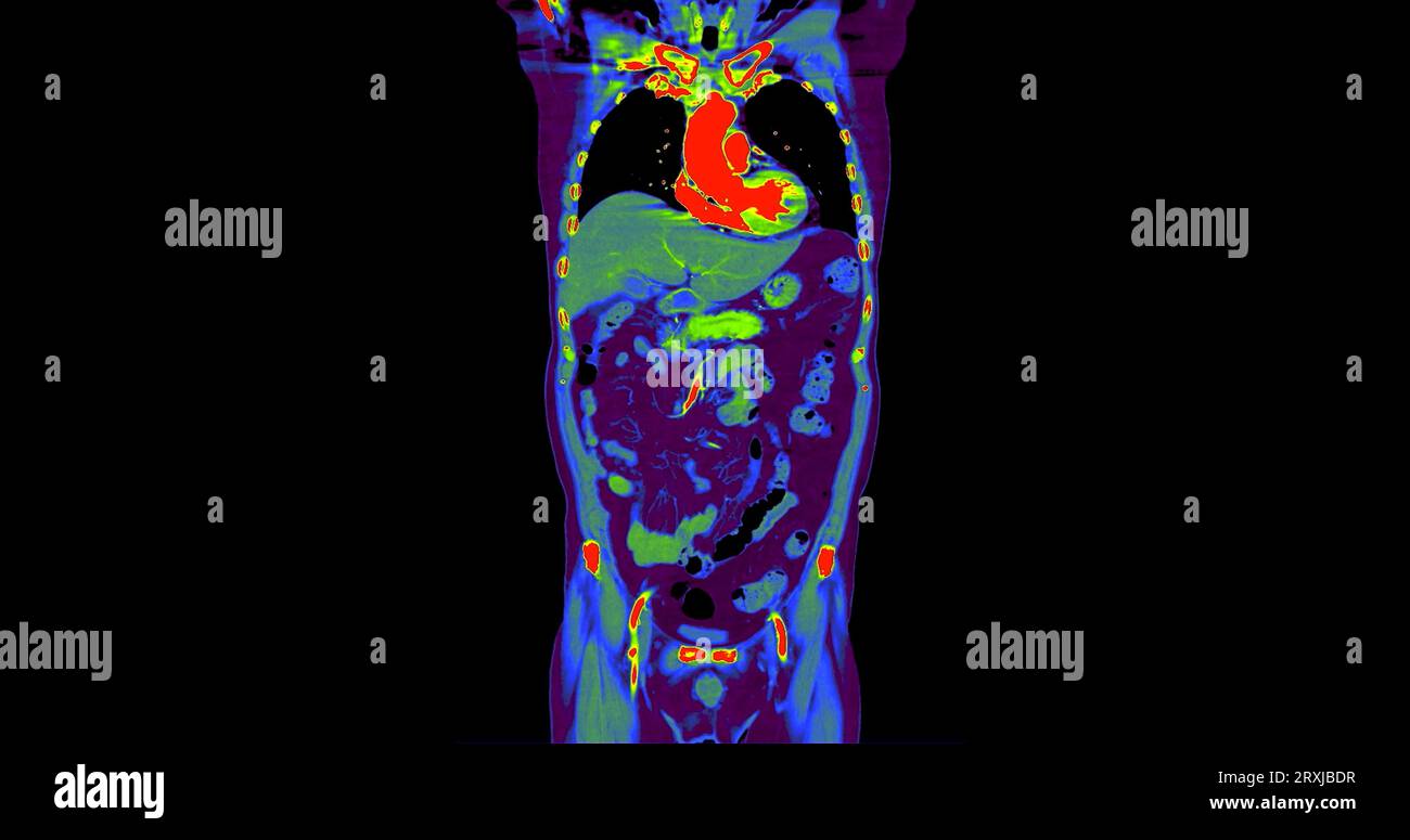 CT Chest and Abdomen with injection contrast media coronal view for