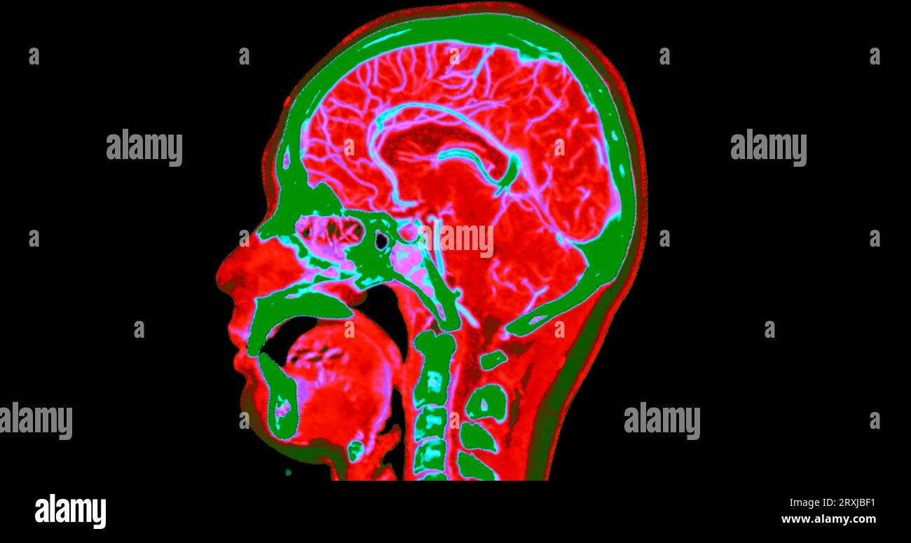 Ct Angiography Of The Brain Or Cta Brain And Neck Sagittal View 3d 