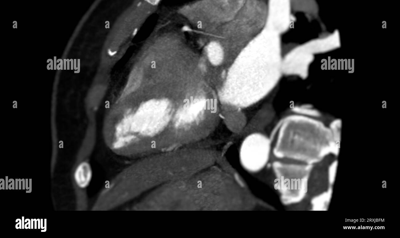 CTA Coronary artery vertival long axis view for diagnosis of vessel coronary artery stenosis. Stock Photo