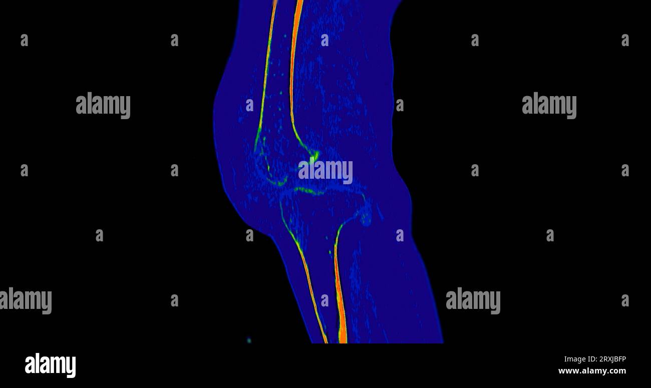 CT Knee or CT Scan image of knee joint sagittal view Stock Photo - Alamy