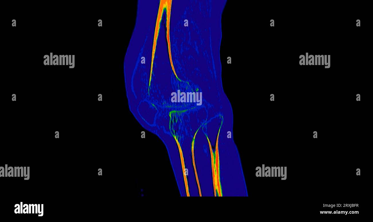 CT Knee or CT Scan image of knee joint sagittal view Stock Photo - Alamy