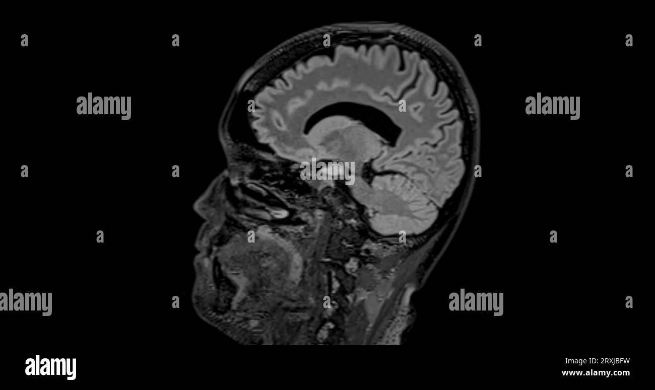 MRI  brain scan  sagittal flair for detect  Brain  diseases sush as stroke disease, Brain tumors and Infections. Stock Photo