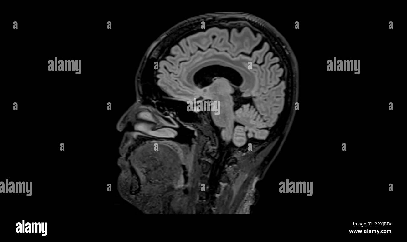 MRI brain scan sagittal flair for detect Brain diseases sush as stroke ...