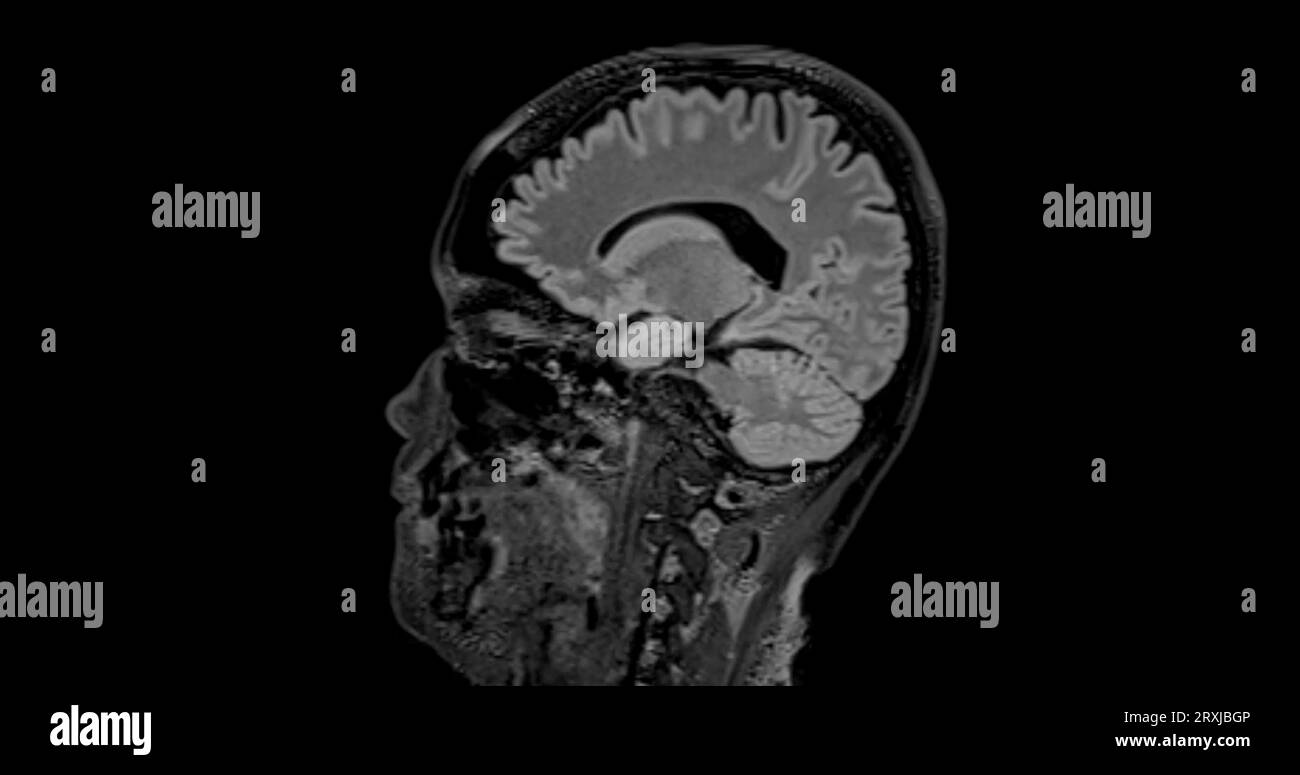 MRI  brain scan  sagittal flair for detect  Brain  diseases sush as stroke disease, Brain tumors and Infections. Stock Photo