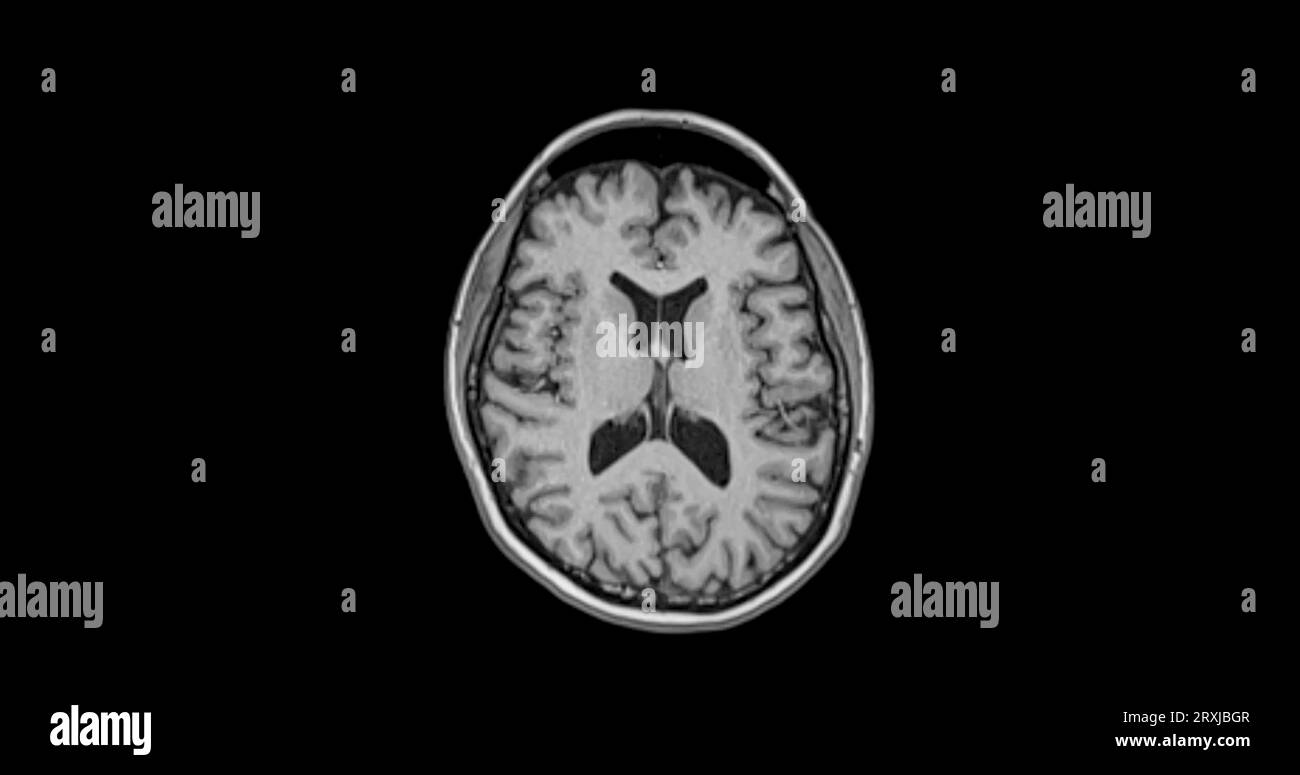 MRI  brain scan  axial view for detect  Brain  diseases sush as stroke disease, Brain tumors and Infections. Stock Photo