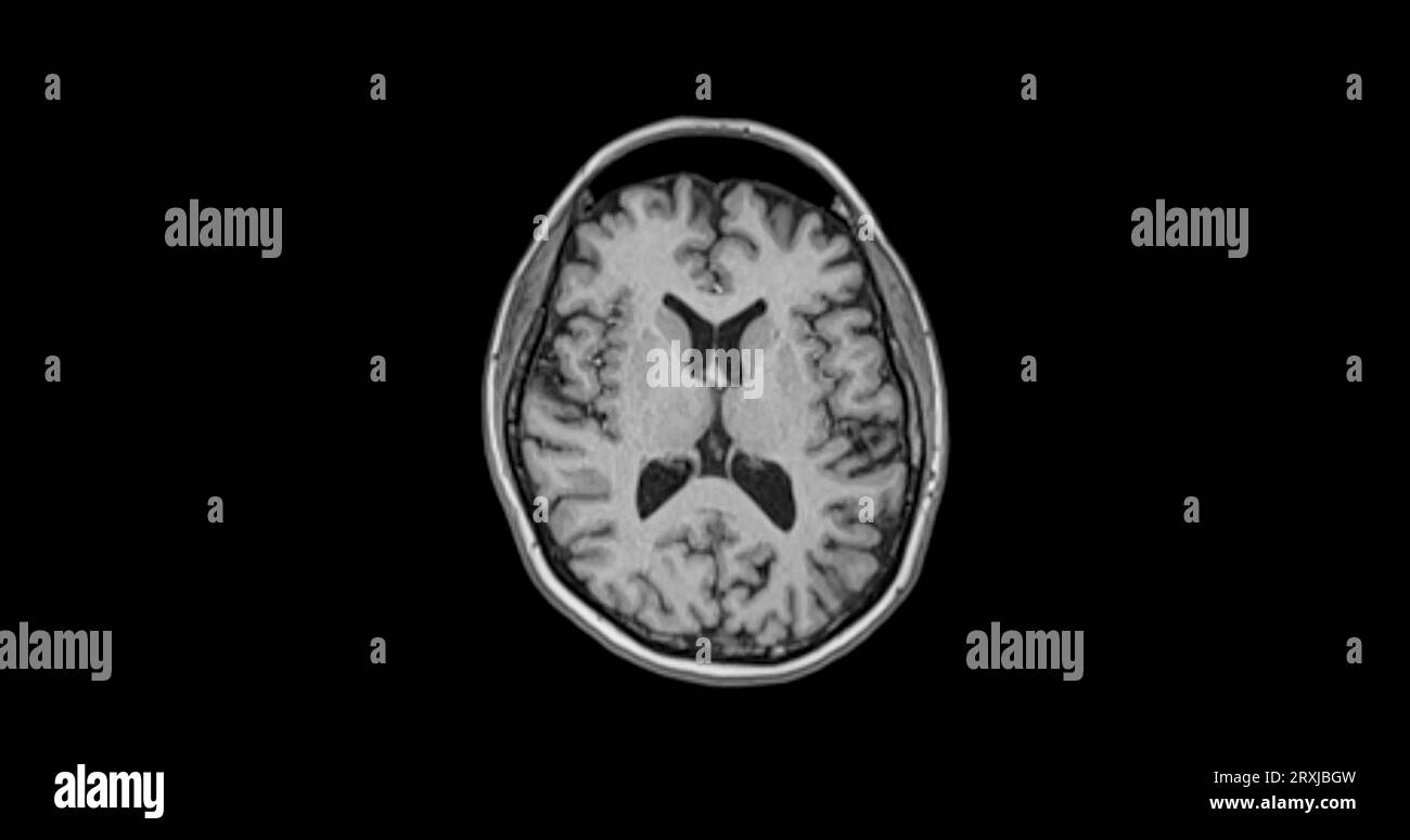 MRI  brain scan  axial view for detect  Brain  diseases sush as stroke disease, Brain tumors and Infections. Stock Photo