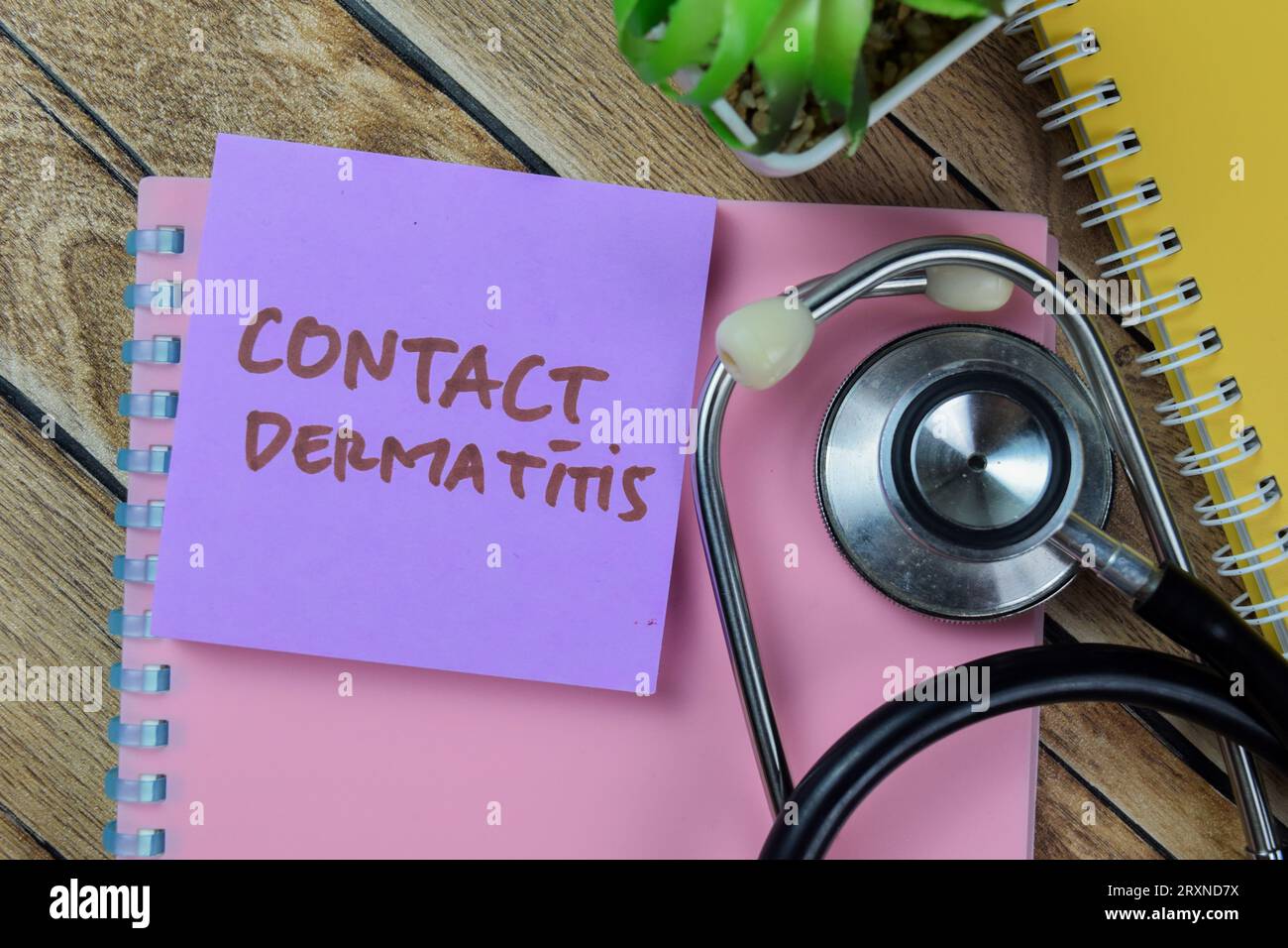 Allergic contact eczema dermatitis rash hi-res stock photography and ...