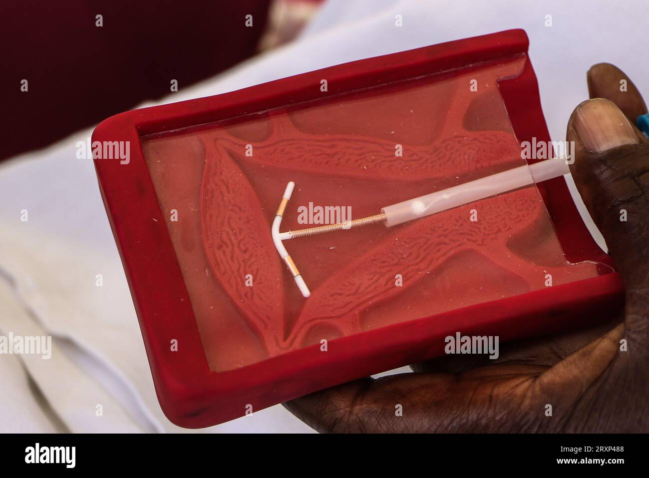 A close-up of a hand demonstrating the correct placement of an Intrauterine Contraceptive Device (IUD) in the Uterus during the national celebrations of The World Contraception Day. According to data from Kenya Demographic and Health Survey (KDHS) Kenya has made significant progress in promoting access to family planning and increasing modern contraceptive prevalence rate from 53% in 2014 to 57% in 2022, with unmet need for family planning reducing slightly from 18% to 14% while teenage pregnancy has fallen from 18% to 15%. Stock Photo