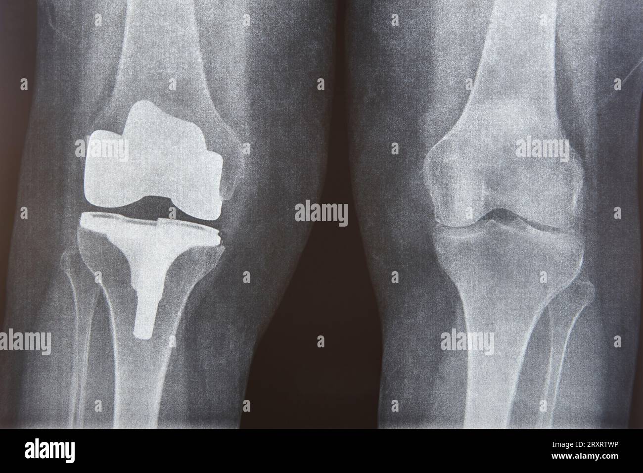 Knee cap replacement xrays. Titanium implant. Osteoarthritis. Articular