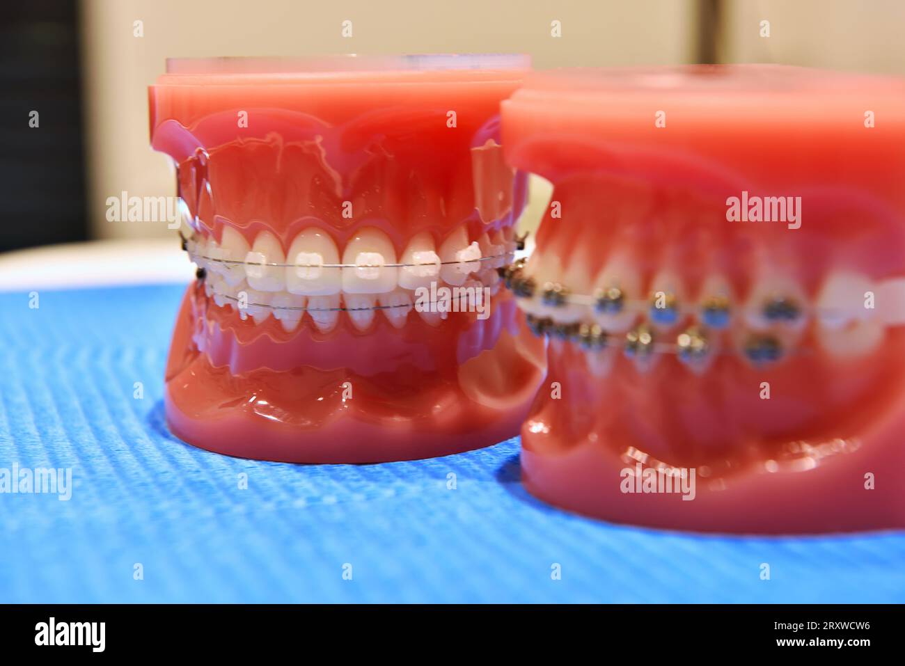 Orthodontic brackets hires stock photography and images Alamy