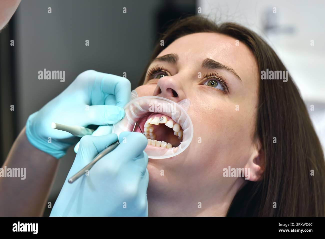 Preparing To Install Braces On Tteeth, Healthcare And Medical Concept