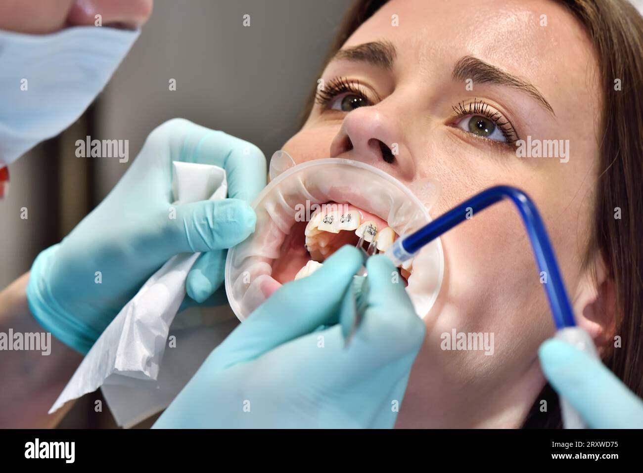 Preparing To Install Braces On Tteeth. Dental Treatment, Healthcare And