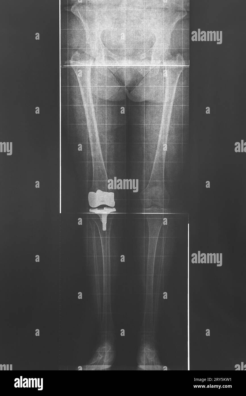 Legs and hip xray. Titanium knee implant. Radiology diagnosis Stock Photo Alamy