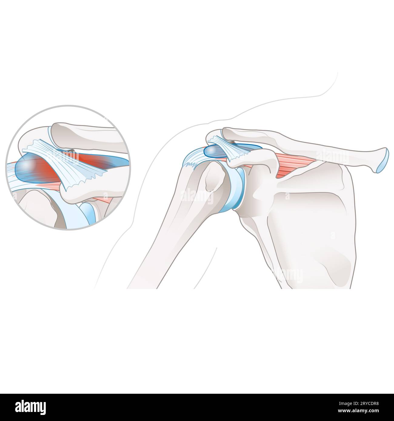 Subacromial bursitis is inflammation of the bursa in the shoulder, causing pain, swelling, and reduced mobility, often associated with rotator cuff is Stock Photo