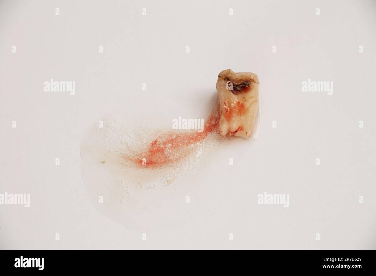 An extracted tooth destroyed by caries and a hole in the middle lies on a white background with