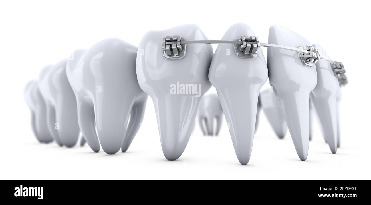 Brackets on the teeth Stock Photo Alamy