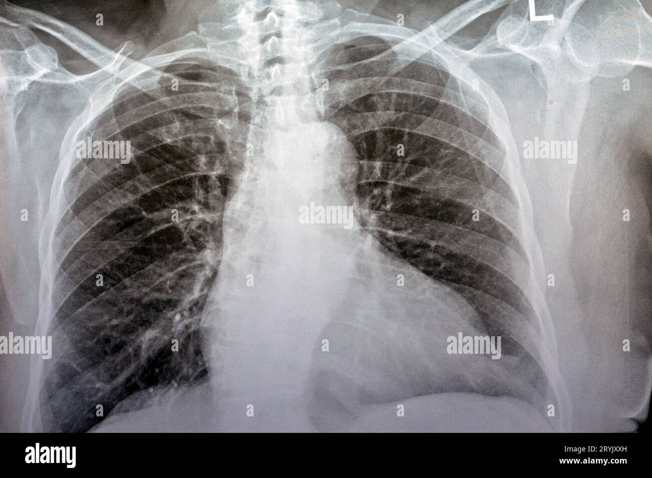 Plain x ray chest of an old woman with almost normal study of bones, lungs and heart, normal chest cavity, ribs and wall, no signs of white patches or Stock Photo