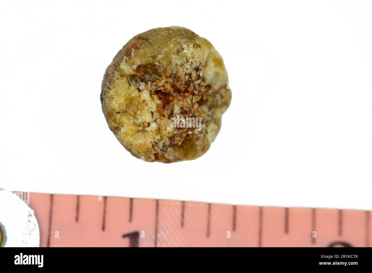 Large gallstone removed surgically after laparoscopic cholecystectomy, Gallstones are hardened deposits of digestive fluid that can form in gallbladde Stock Photo