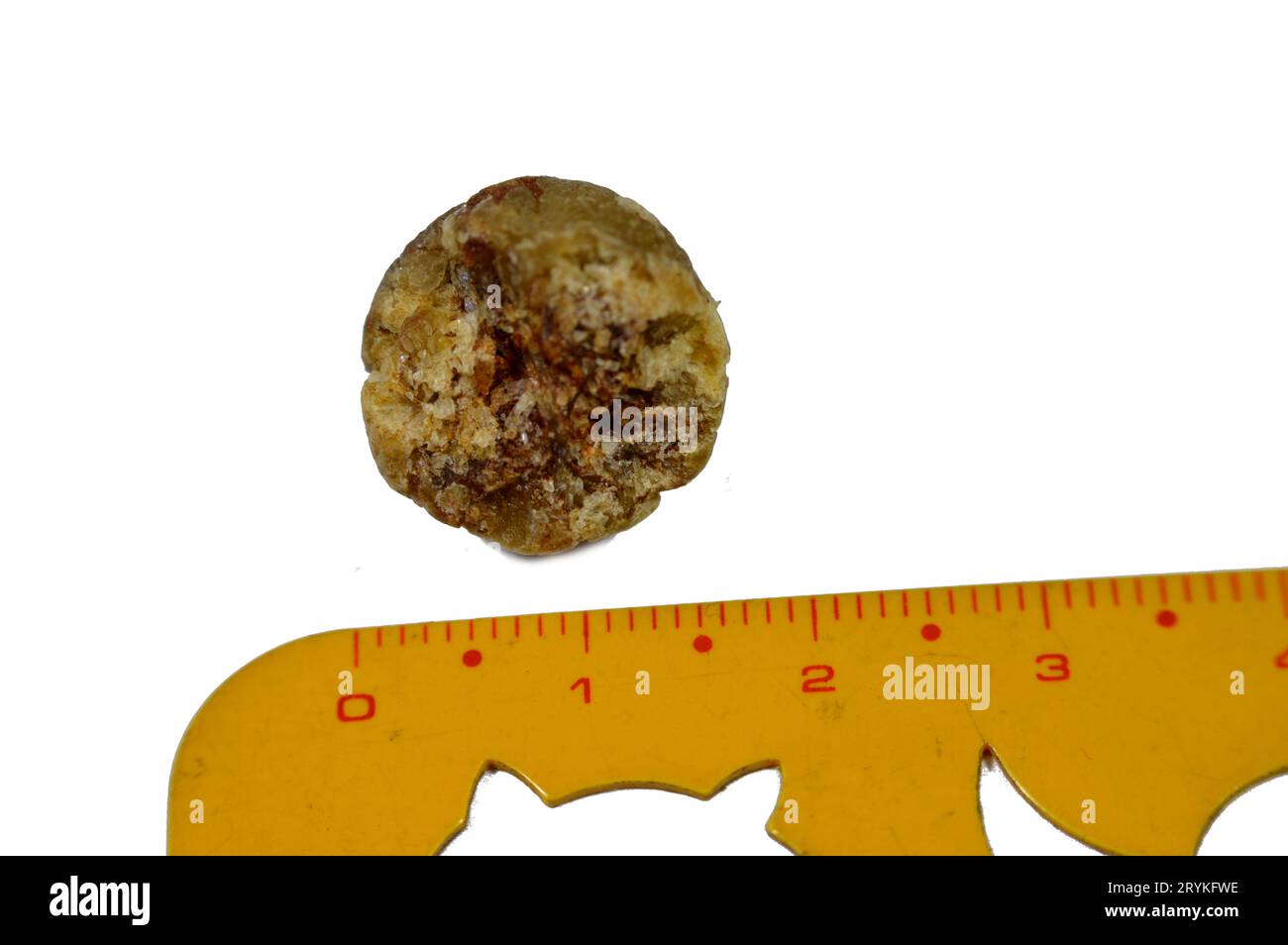 Large gallstone removed surgically after laparoscopic cholecystectomy, Gallstones are hardened deposits of digestive fluid that can form in gallbladde Stock Photo