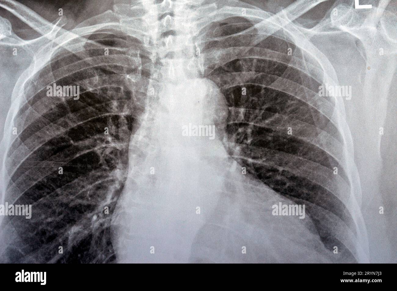 Plain x ray chest of an old woman with almost normal study of bones, lungs and heart, normal chest cavity, ribs and wall, no signs of white patches or Stock Photo
