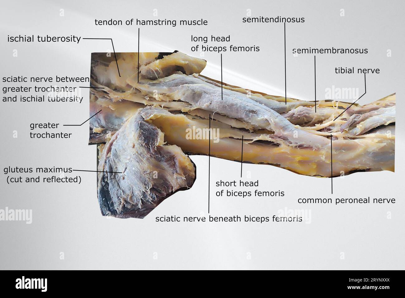 dissection image of the muscle of the thigh with showing sciatic nerve ...
