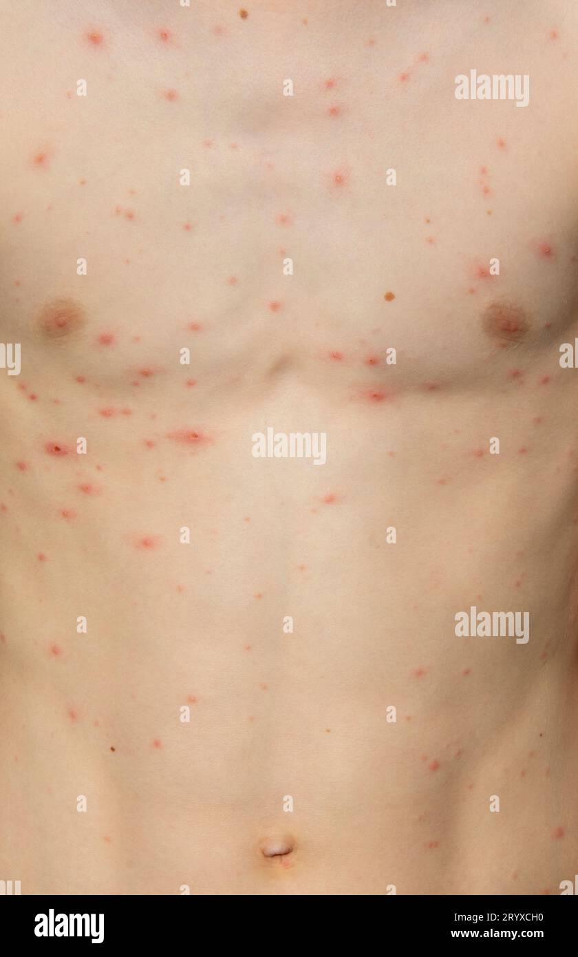 Chickenpox rash on a body of a young boy. Chickenpox is a contagious ...
