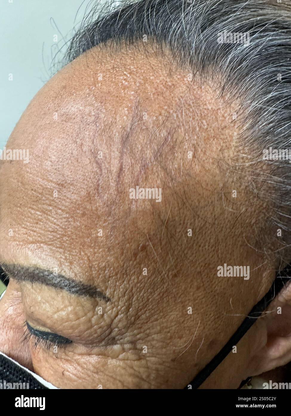 frontal-fibrosing-alopecia-affecting-an-african-american-female-patient