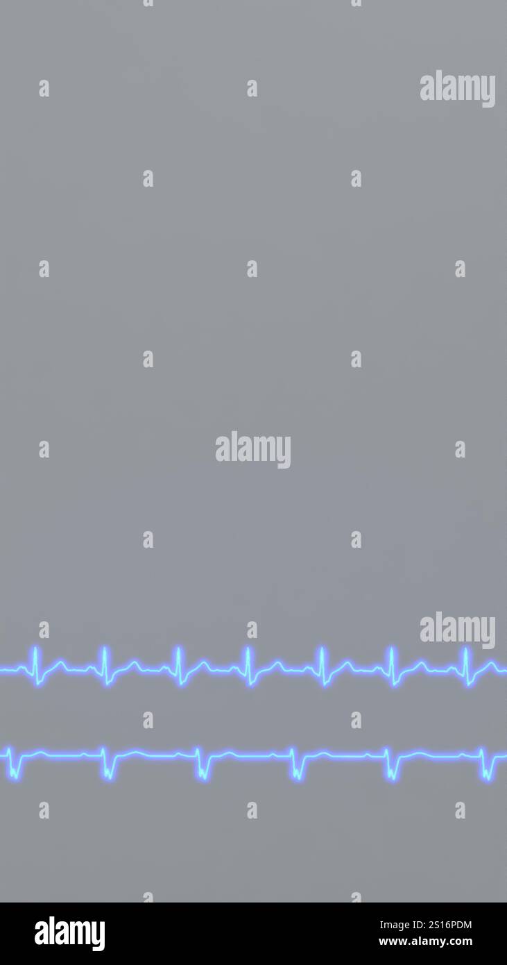 ECG of cardiac arrhythmias. Right bundle branch block and left bundle ...