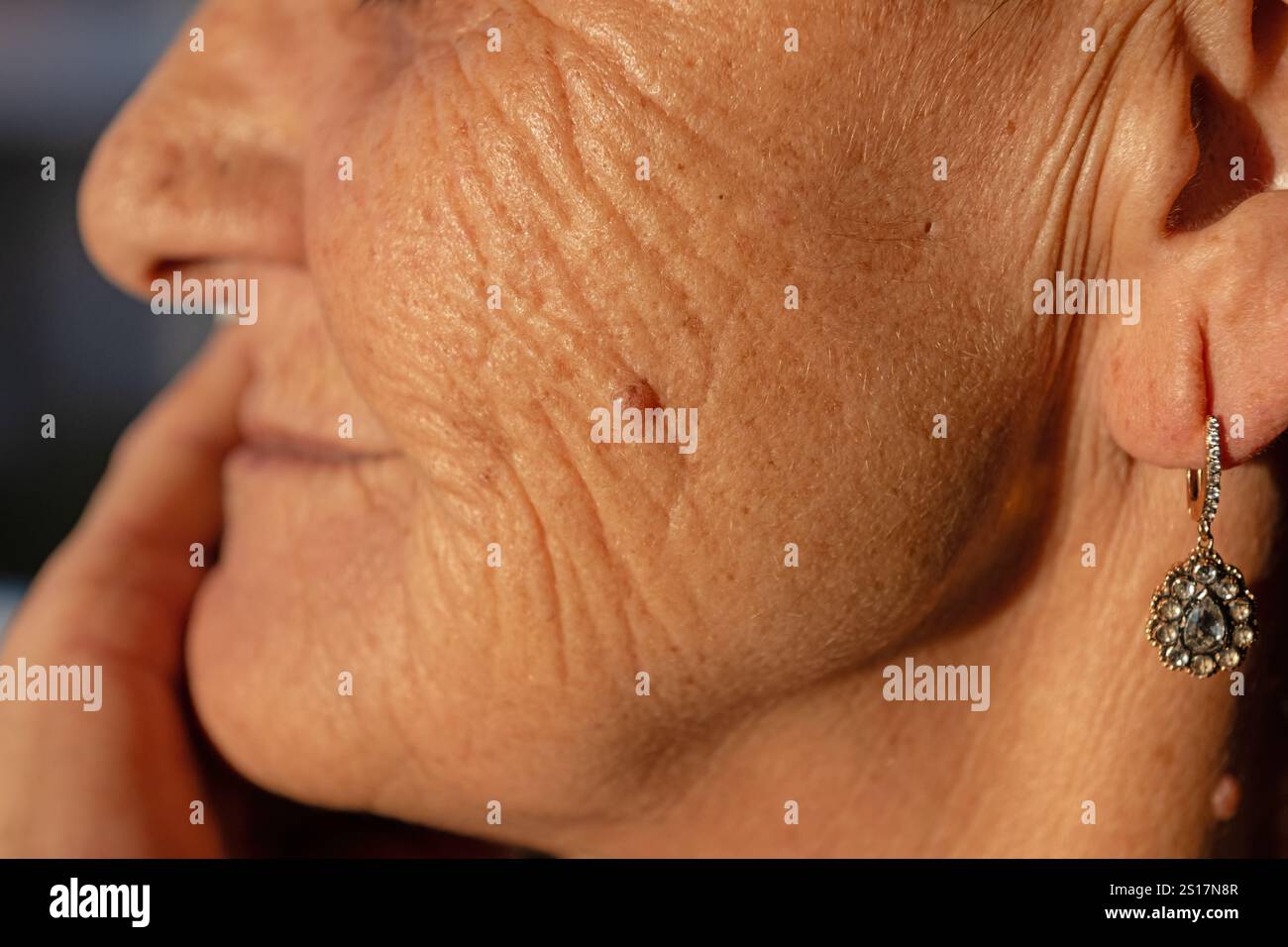 Moles on an old woman's face. Stock Photo