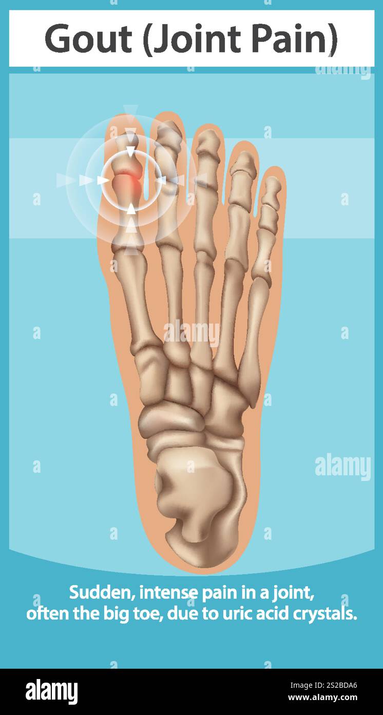 Illustration of gout affecting the big toe joint Stock Vector Image ...