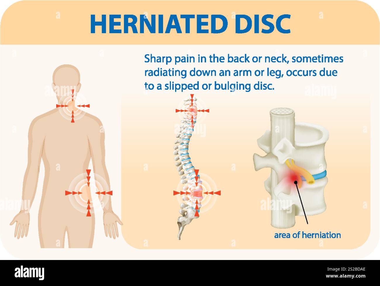 Illustration of herniated disc and associated pain areas Stock Vector ...
