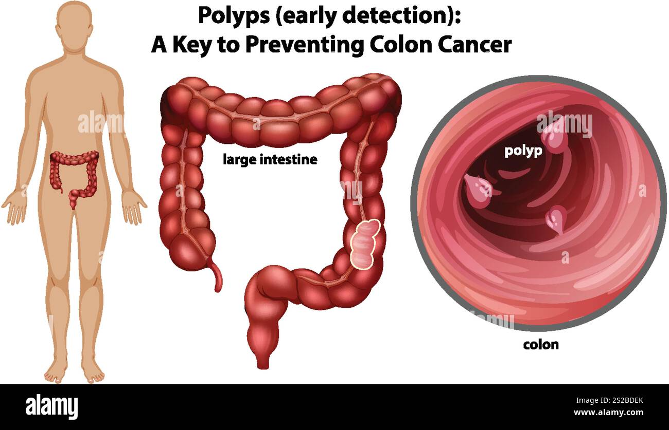 Illustration of colon polyps and early detection Stock Vector Image ...