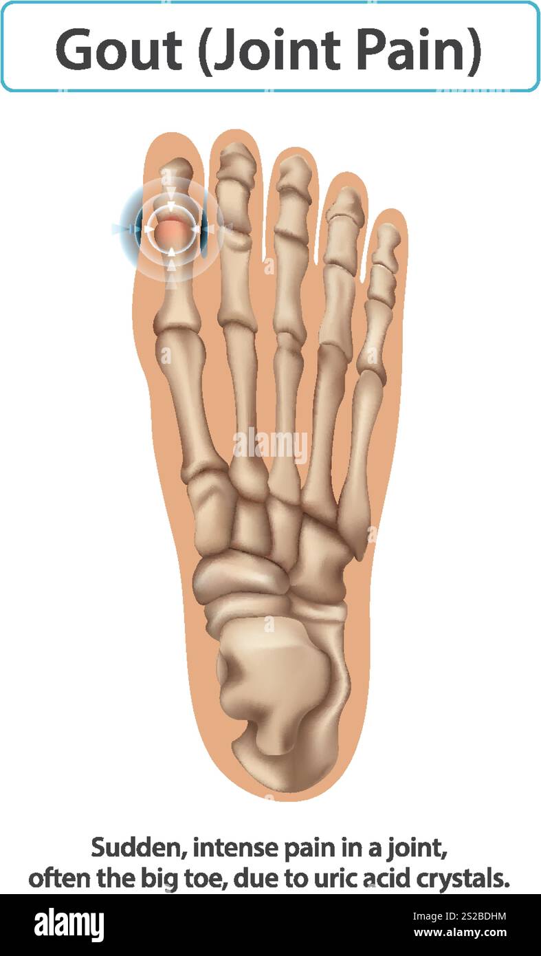 Illustration of gout affecting the foot joint Stock Vector Image & Art ...