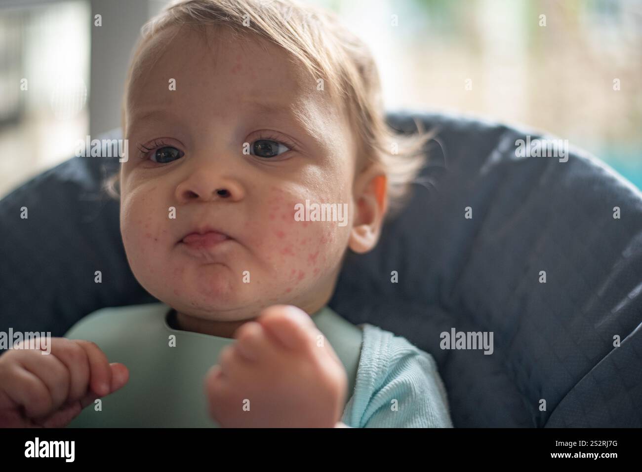 9-month-old baby with skin rash eating Stock Photo - Alamy