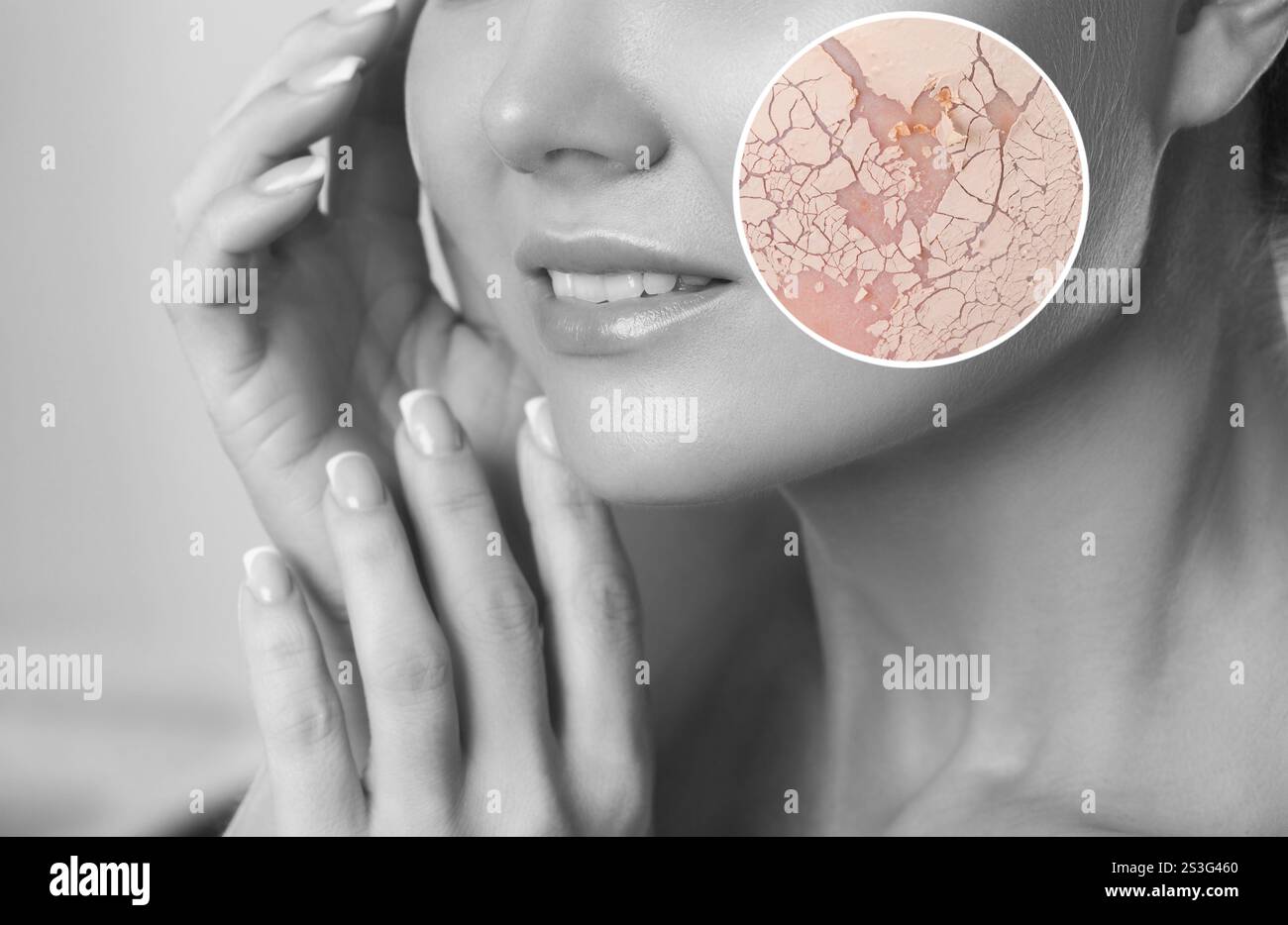 Problematic skin hi-res stock photography and images - Alamy