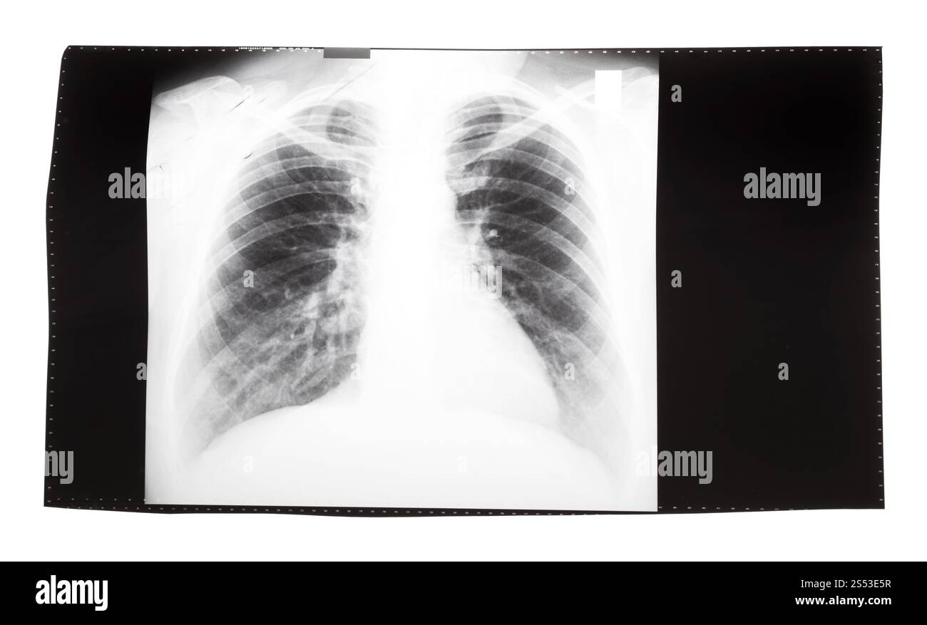 film with X-ray image of front view of human thorax isolated on white ...