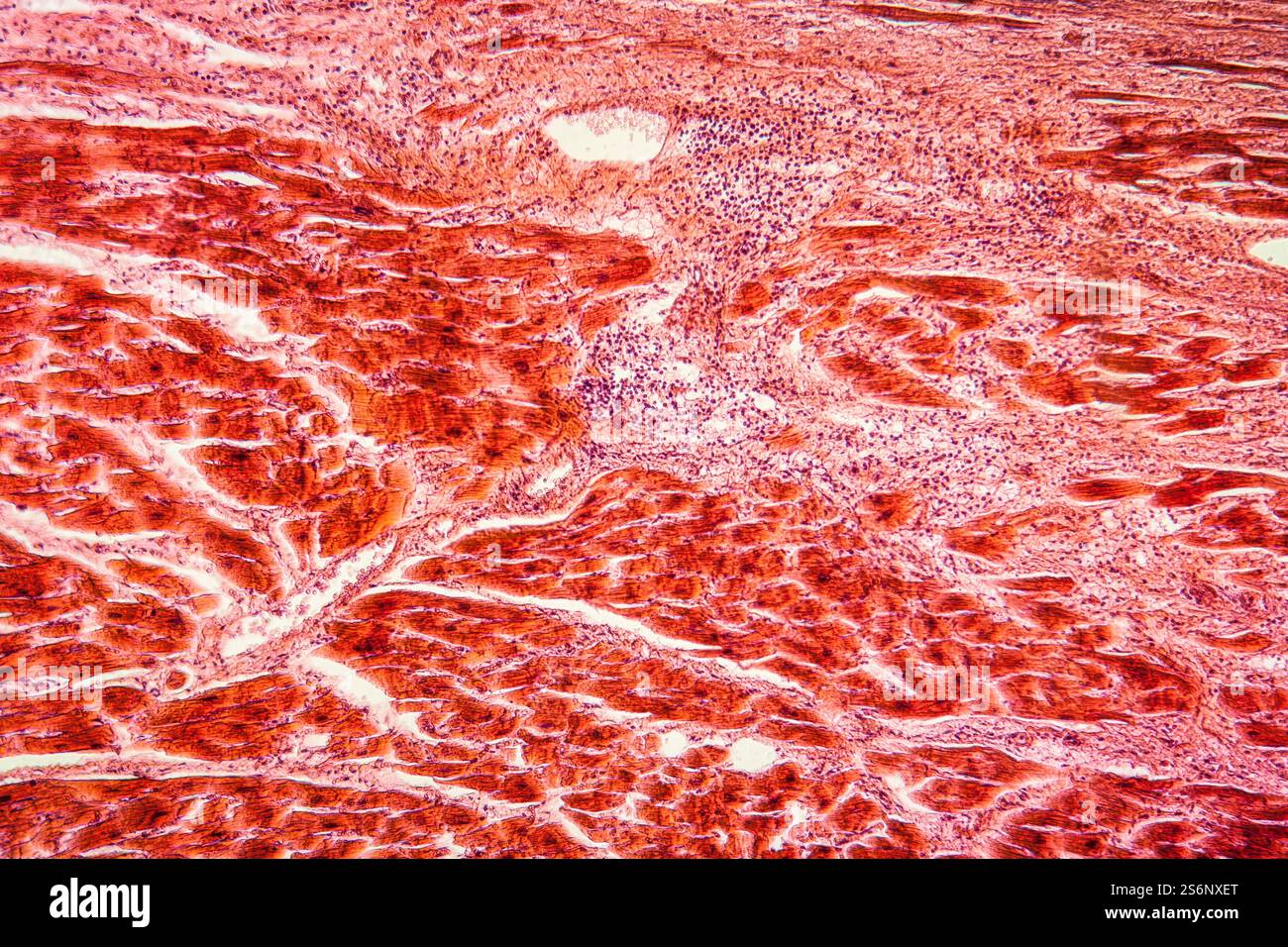 Diseased tissue 100x Stock Photo