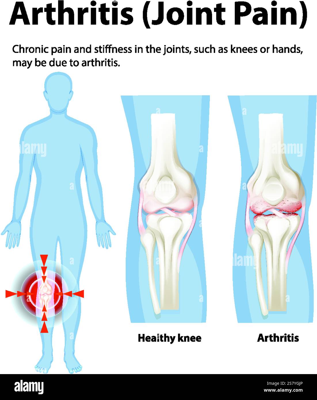 Illustration of knee joint health and arthritis Stock Vector Image ...