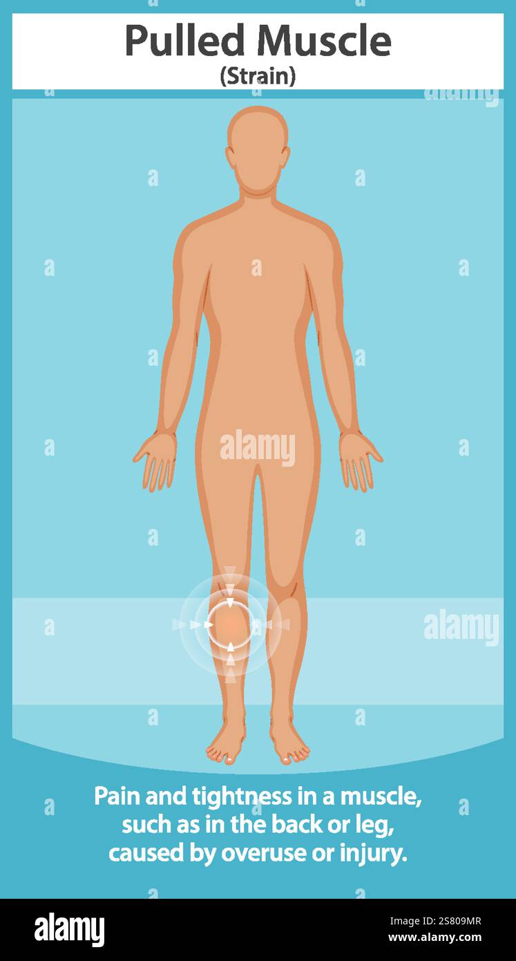 Strained Muscles Antomy Example Illustration of muscle strain in human body Stock Vector Image & Art ...