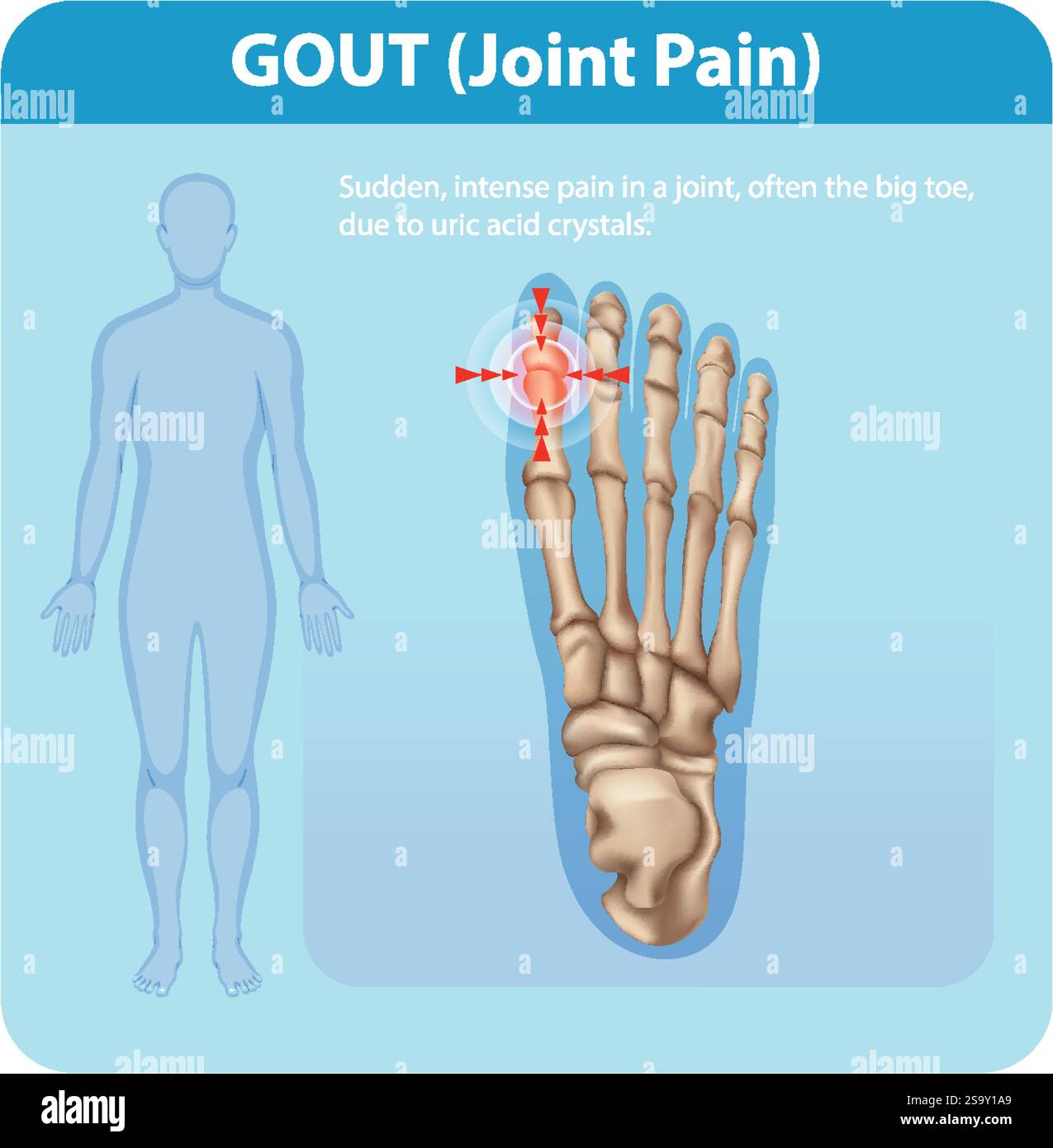 Illustration of gout affecting the big toe joint Stock Vector Image ...