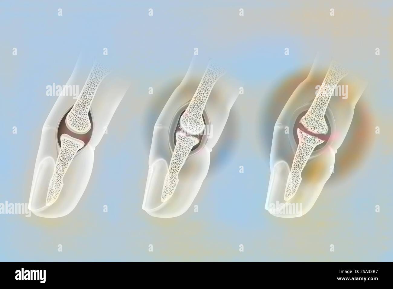 Finger osteoarthritis. Left: healthy joint. Middle: moderate osteoarthritis. The cartilage is worn, the cartilaginous debris causes inflammation of th Stock Photo