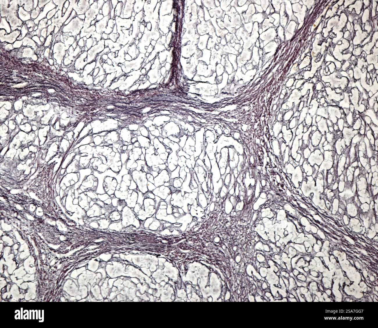 Liver Reticular Light micrograph of a human liver with micronodular cirrhosis, a ...