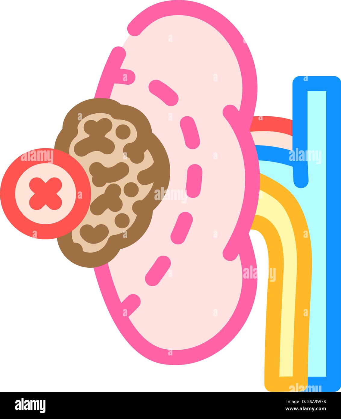 Nephrectomy hi-res stock photography and images - Alamy