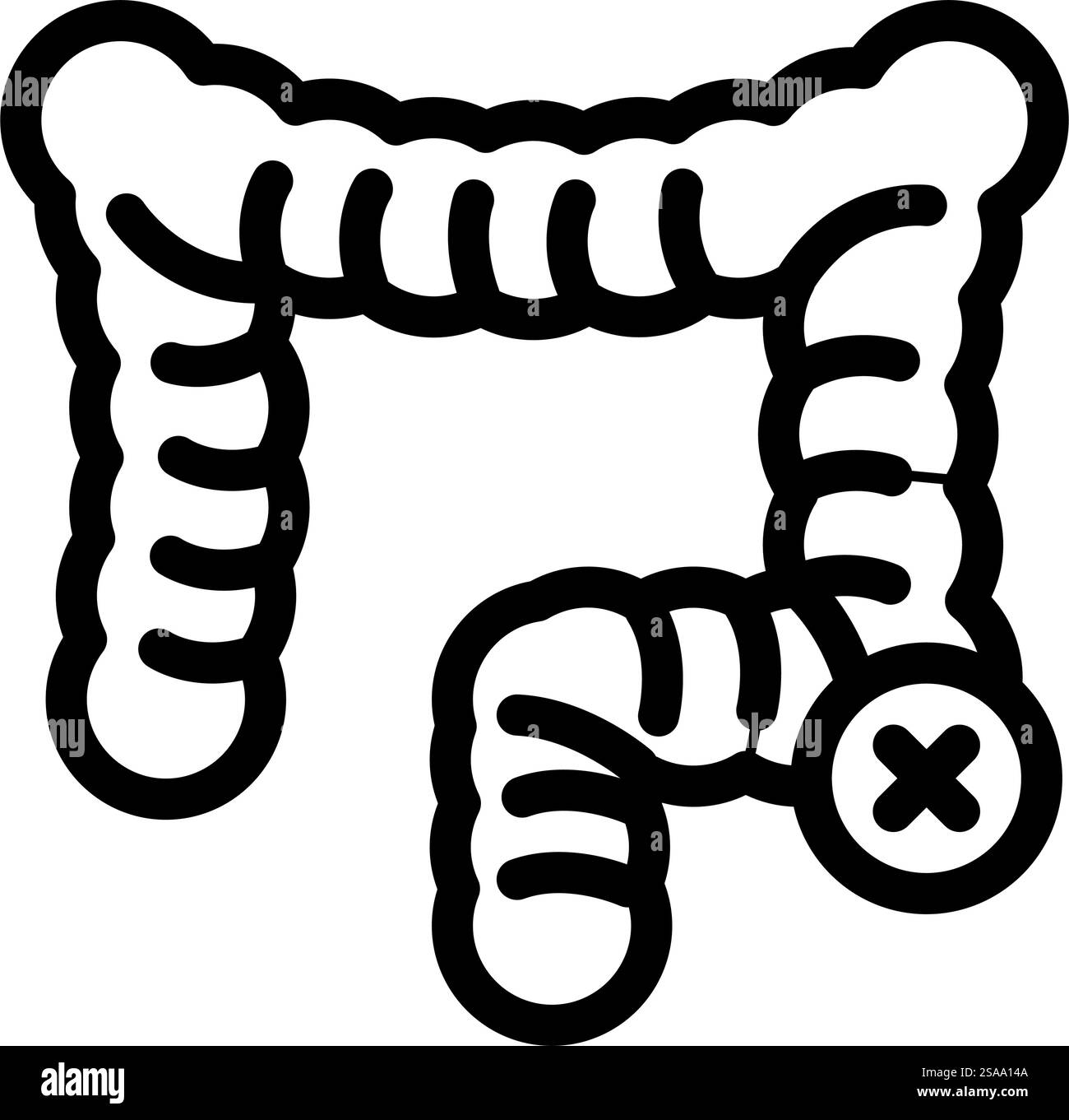 Bowel resection hi-res stock photography and images - Alamy