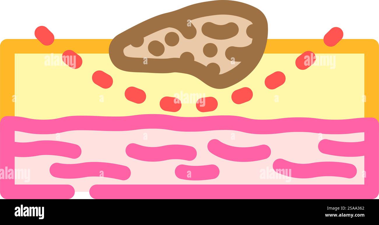 excisional biopsy surgery color icon vector. excisional biopsy surgery ...