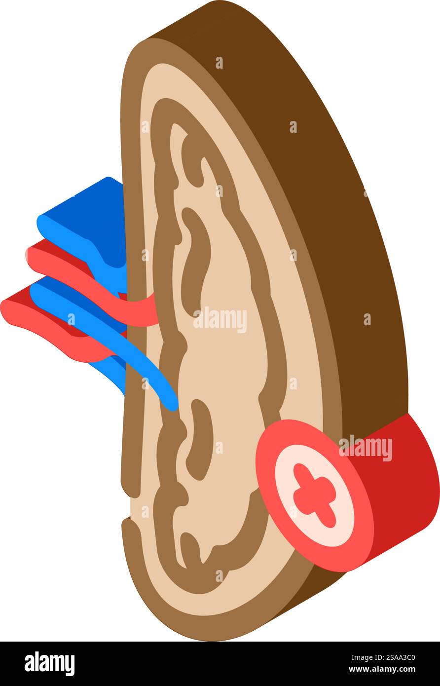 splenectomy surgery isometric icon vector. splenectomy surgery sign ...